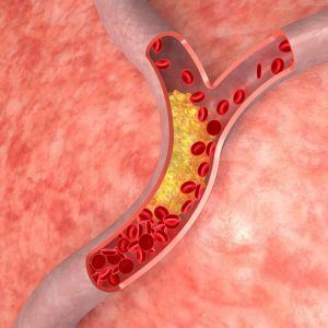 Arterias taponadas por grasa, el colesterol
